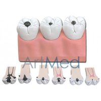 Modelo Cáries Dentárias | ArtMed