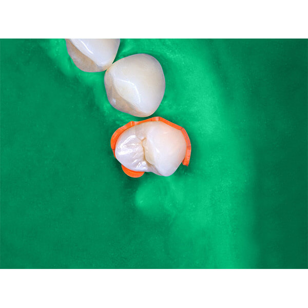 Amarrilhos Isolamento Absoluto Angelus