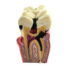 Modelo Dente Molar Corte Transversal c/ cárie ArtMed