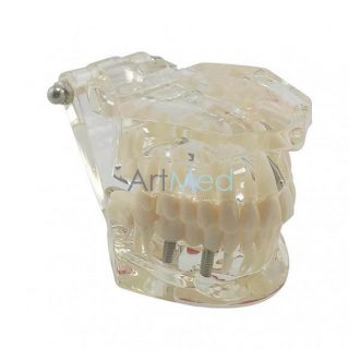 Modelo Dentário Adulto com Implantes | ArtMed