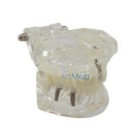 Modelo Dentário Implantes & Patologias - Transparente | ArtMed