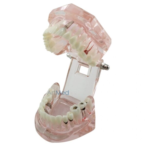 Modelo Dentário Implantes & Patologias - Rosa | ArtMed