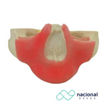 Maxila Edêntula Com Gengiva | Nacional Ossos